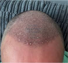 Image result for folliculitis symptoms