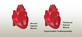 Image result for Cardiomyopathy