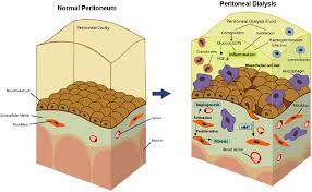 The asbestos fibers cause inflammation and scarring to mesothelial cells. The Mesothelial To Mesenchymal Transition A Pathogenic And Therapeutic Key For Peritoneal Membrane Failure Intechopen