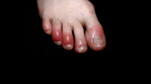 A new chinese coronavirus, a cousin of the sars virus, has infected hundreds since the outbreak began in wuhan, china, in december. What Is Covid Toe Maybe A Strange Sign Of Coronavirus Infection The New York Times