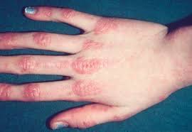 Holodovoj Rinit Allergicheskaya Reakciya Na Holod Simptomy I Lechenie U Vzroslyh Gorodskaya Klinicheskaya Bolnica 1