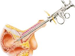 An infection or a tumor can also make the prostate larger. Prostate Functions Diseases And Tests