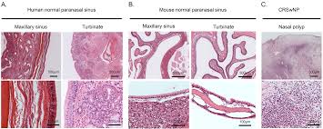 Rhinitis is the inflammation of the mucosa overlying the nasal cavity. Medical Sciences Free Full Text Eosinophilic Upper Airway Inflammation In A Murine Model Using An Adoptive Transfer System Induces Hyposmia And Epithelial Layer Injury With Convex Lesions Html