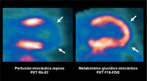 Resultado de imagen de La técnica combinada PET/CT es uno de los desarrollos más excitantes de la medicina nuclear