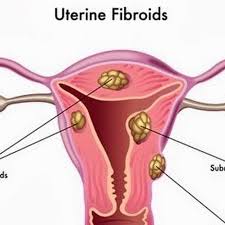 They can be microscopic as well as macroscopic. Uterine Fibroids Natural Treatment Youtube