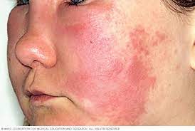 Hives And Angioedema Symptoms And Causes Mayo Clinic