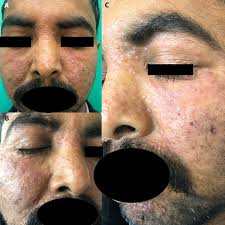 A) Multiple, discrete reddish brown papules over both cheeks, nose,...