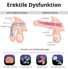Erektionsstörung (Impotenz) » Ursachen, Behandlung