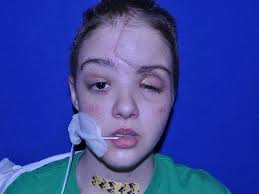 22-Year-Old Whose Life Was Forever Changed After Texting and Driving Shares  Her Difficult Story With Others: 'I Was Warned'