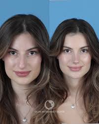 Cindy Nose Vs Barbie Nose