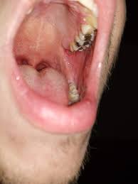 Normally, the sockets should take about 2 weeks to 1 month to cover over with solid gum tissue after scabbing first; Guys Please Help Wisdom Tooth Made Me A Crater Like Hole In My Mouth Should I Be Worried How Dangerous This Can Get Have Any Of You Had Something Simllar Happen To