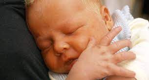 La Piel Del Bebe Esta Amarilla Ictericia Neonatal Pequesalus