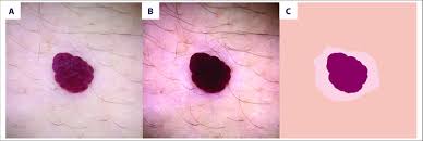 Like warts, cherry angioma is known as the most common kind of angioma, red in appearance. A Pale Halo Around A Cherry Angioma A The Original Image B Its Download Scientific Diagram