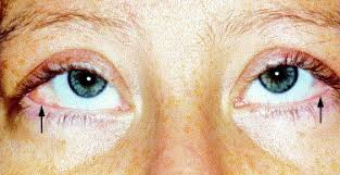 Diagnostic tests are performed to detect any mutations in the sh3bp2 gene. Orbital Involvement In Cherubism Ophthalmology