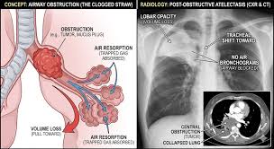 Image result for Atelectasis