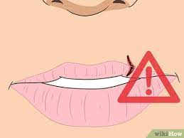 Shallow cuts usually heal on their own without stitches, while deep cuts. 3 Ways To Heal A Split Lip Wikihow