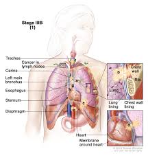 The lungs and respiratory system allow us to breathe. Non Small Cell Lung Cancer Treatment Mhealth Org