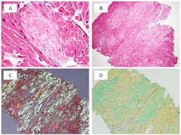 Amyloid is homogeneous and eosinophilic, the deposits are extracellular and may become sufficiently large enough to cause damage to surrounding tissues. Technetium 99m Pyrophosphate Spect For Ttr Amyloid American College Of Cardiology
