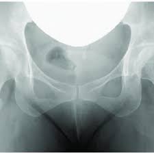 Image result for Log Roll Test