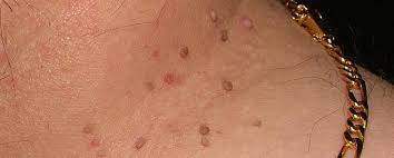 Verrugas En El Cuello Fibromas Blandos Cd Iselamendez