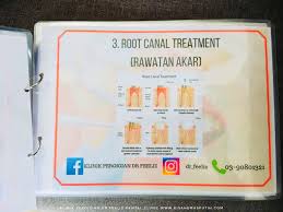 Root canal treatment (atau disebut juga endodontic treatment. Buat Rawatan Whitening Teeth Putihkan Gigi Di Klinik Pergigian Dr Feeliz Dental Clinic Emas Putih