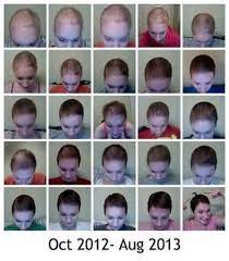 45 Ideas Hair Growth After Chemo Natural Hair Growth After Chemo Boost Hair Growth Grow Thick Hair Naturally