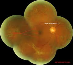 Ophthalmologists occasionally perform cryotherapy if the location of the tear makes it difficult to perform laser photocoagulation. Retinal Detachment Optical Coherence Tomography Scans