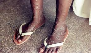 Monkeypox is a rare disease that occurs primarily in the rainforest countries of central and west africa. Two Cases Of Monkeypox Reported In The Uk What Is It And How Is It Similar To Smallpox The Week