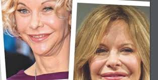 Meg Ryan, l'une de pires ratées de la chirurgie esthétique (photo)