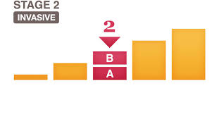 What is a cancer stage? Stage 2 Ii And Stage 2a Iia National Breast Cancer Foundation