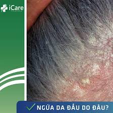 Da đầu bị ngứa và bong vảy do rối loạn nội tiết tố. Nguyen Nhan Bá»‹ Ngá»©a Da Ä'áº§u Da Ä'áº§u Bong Troc Váº£y Va Cac Biá»‡n Phap Giáº£m Ngá»©a Da Ä'áº§u Hiá»‡u Quáº£ Icare Pharma