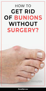 How To Get Rid Of Bunions Without Surgery Get Rid Of Bunions Bunion How To Get Rid