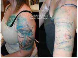 Surgery:this involves cutting out the tattoo under local anesthetic and stitching the skin back however, laser removal may rarely cause scarring and pigmentary changes, especially if the tattoo. Facebook