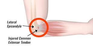 Tears of the biceps tendon at the elbow are uncommon. Is Tennis Elbow Curable Exercises For Tennis Elbow