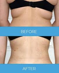 While The Distinction In Terms Of Vaser Lipo Vs Laser Lipo Is Always A Subjective Matter For Many It Is Wise Cosmetic Surgery Vaser Lipo Best Plastic Surgeons