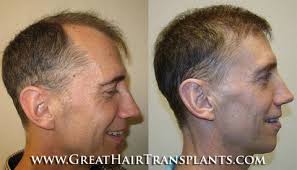 Male Pattern Hair Loss Treatment in New Jersey Cape May Ocean View