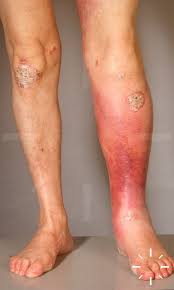 Image result for erysipel photos)