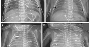 Nou nascutii cu ttn si pneumonie sau sam. Sindromul De Detresa Respiratorie La Prematuri