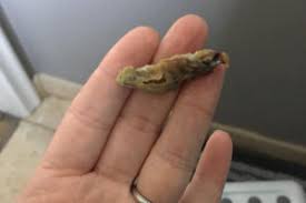 Nasal Irrigations Prevent And Treat Crusting Nfed