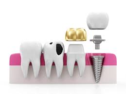 Dental crown pain may occur if a crown is placed on a tooth incorrectly. What To Do If Your Crown Falls Off On A Weekend Or At Night