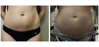 They're common in pregnant women, especially during the last trimester. Stretch Mark Removal Orlando Winter Park Laser