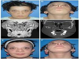 Cherubism is an autosomal dominant disorder that may be related to tooth development and eruption. Cherubism Best Clinical Practice Orphanet Journal Of Rare Diseases Full Text