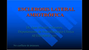 La esclerosis lateral amiotrofica es una enfermedad neurodegenerativa que tiene consecuencias devastadoras para el paciente y su familia. Esclerosis Lateral Amiotrofica Youtube
