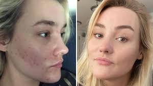 What happens if i take too much. Reddit User I Cured My Horrible Acne In One Week By Doing One Thing 7news