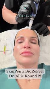 Session two of four of our “Perfect Duo” treatment for @dr.alliednp! ,  Pairing BioRePeel with SkinPen microneedling drastically increases collagen  and elastin in the skin, giving you a more full and ...