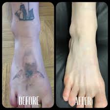 Tattoo removal has been performed with various tools since the start of tattooing. Laser Tattoo Removal Cost Laser Tattoo Removal Center Near Me