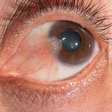 Gozde Et Yurumesi Pterjium Tedavisi Kaskaloglu Goz Hastanesi Izmir