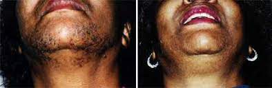 Dermatologists, laser hair removal, tattoo removal. Laser Hair Removal Washington Dc Center For Laser Surgery