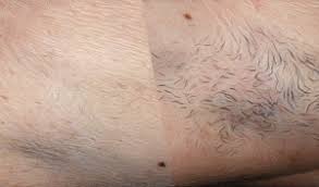 Medical spas, laser hair removal, skin care. Laser Hair Removal Hiq Computers