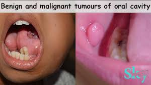 In a medical context, the word malignant is used to describe harmful masses or tumors that are cancerous and that grow and spread disease. Benign And Malignant Tumours Of Oral Cavity
